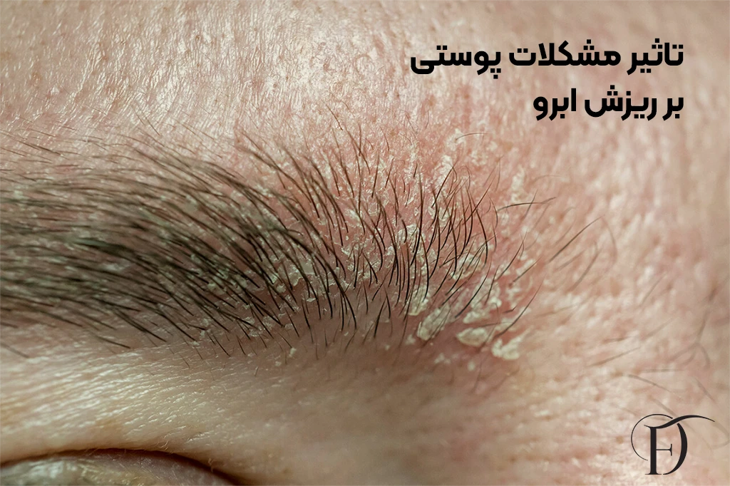 مشکلات پوستی و ریزش ابرو