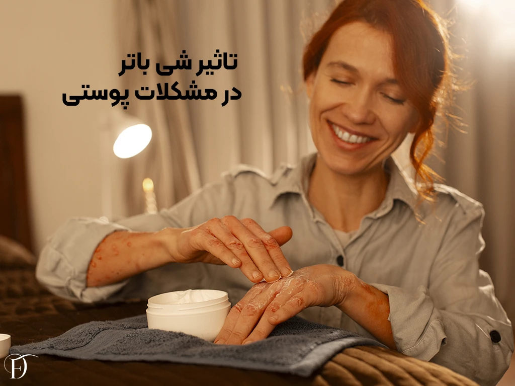 خواص شی باتر در مشکلات پوستی