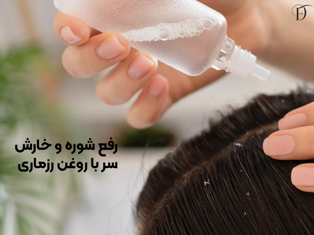 درمان شوره،خارش و پوسته پوسته شدن سر با رزماری 