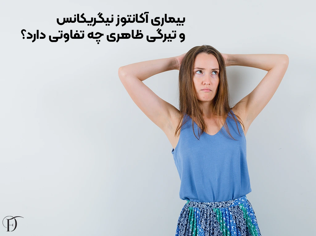 بیماری (آکانتوز نیگریکانس) و تیرگی ظاهری چه فرقی دارد؟