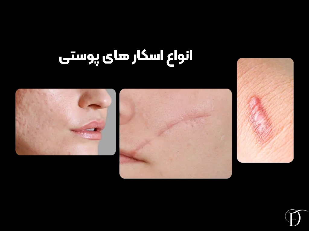 انواع اسکار های پوستی