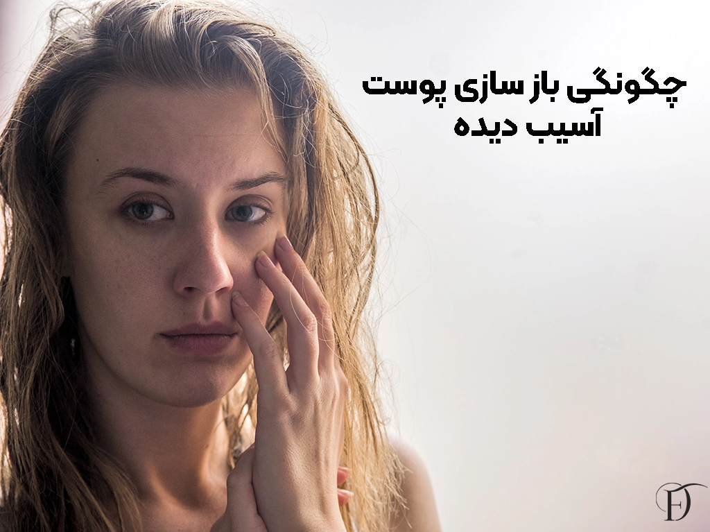 باز سازی پوست آسیب دیده