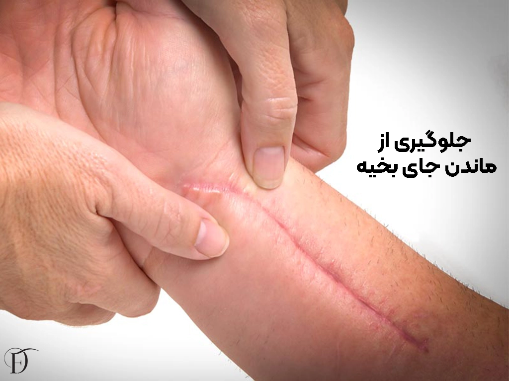 از بین بردی جای بخیه