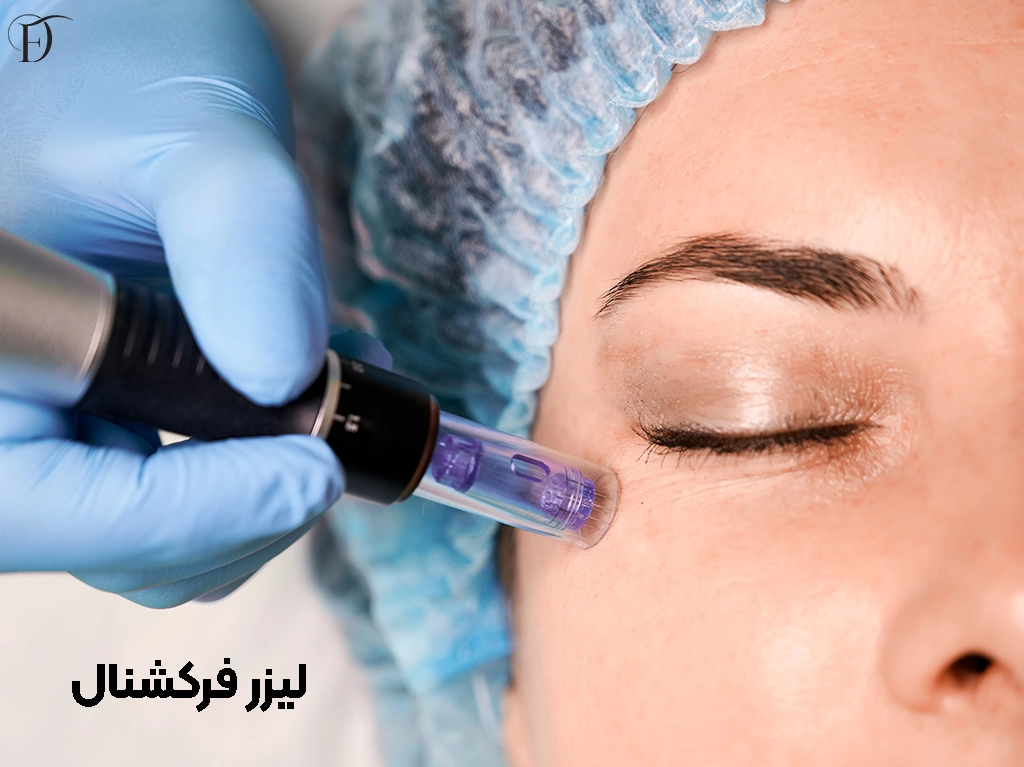لیزر فرکشنال(کربن دی‌اکسید یا RF)