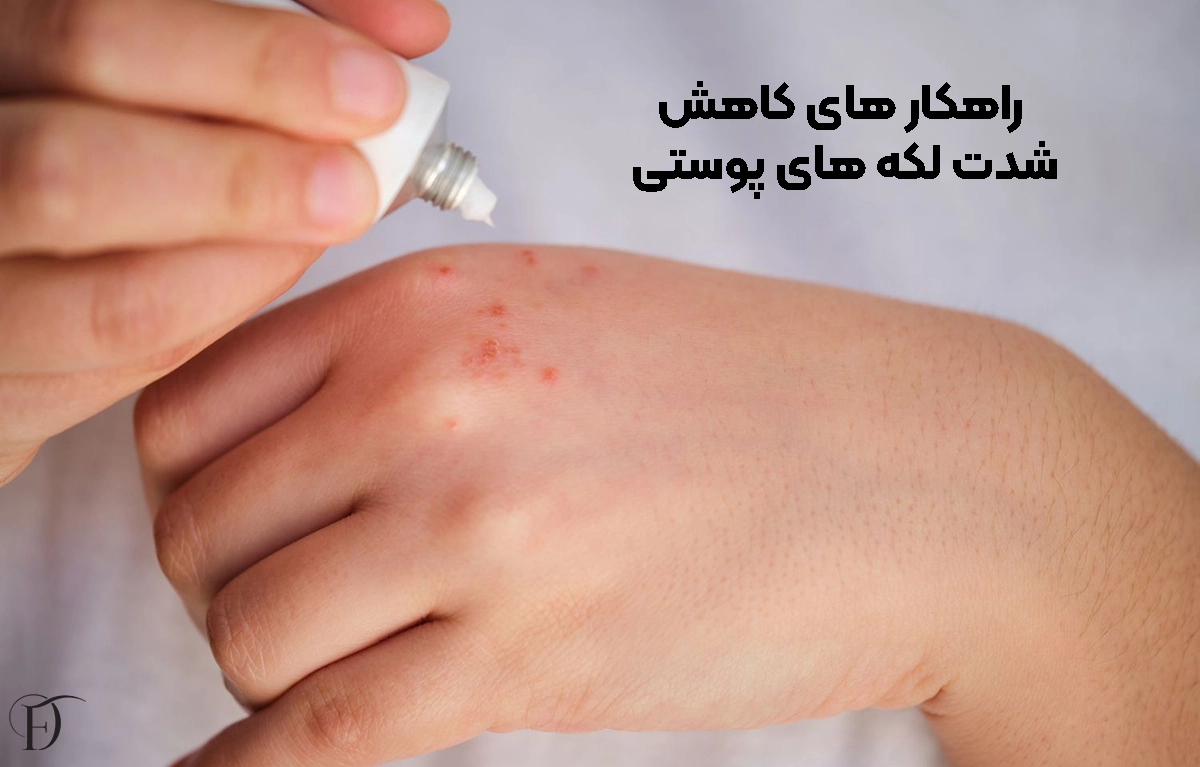 راهکار های درمان و شدت لکه ها پوستی