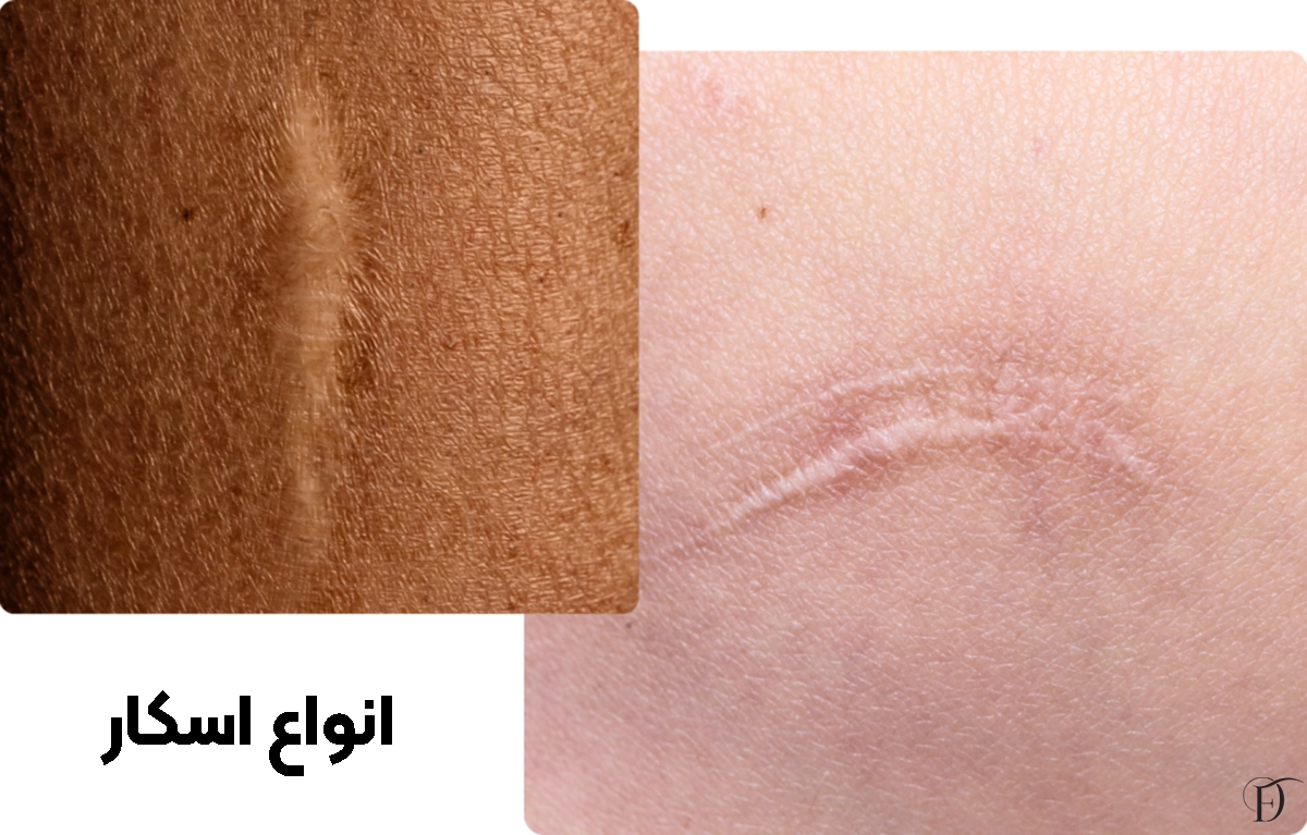 انواع رایج اسکار