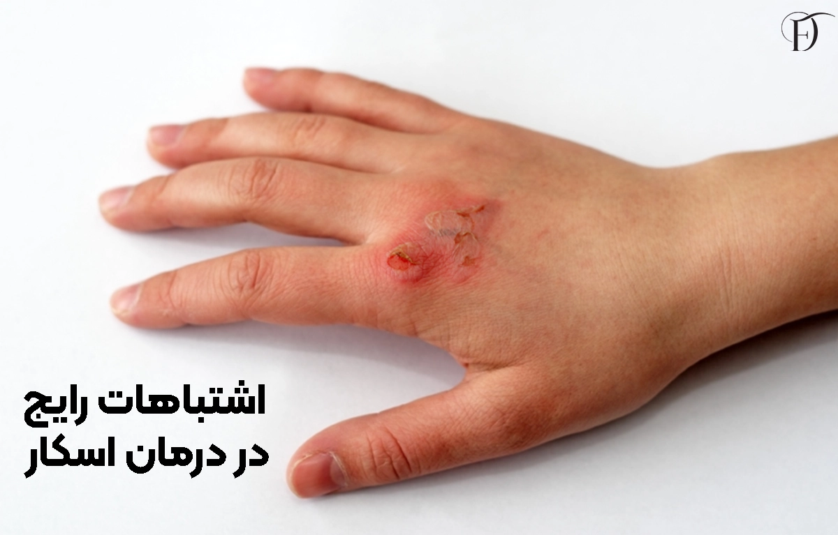 اشتباهات در درمان اسکار