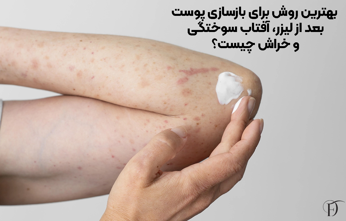 بهترین روش برای بازسازی پوست بعد از لیزر، آفتاب ‌سوختگی و خراش چیست؟