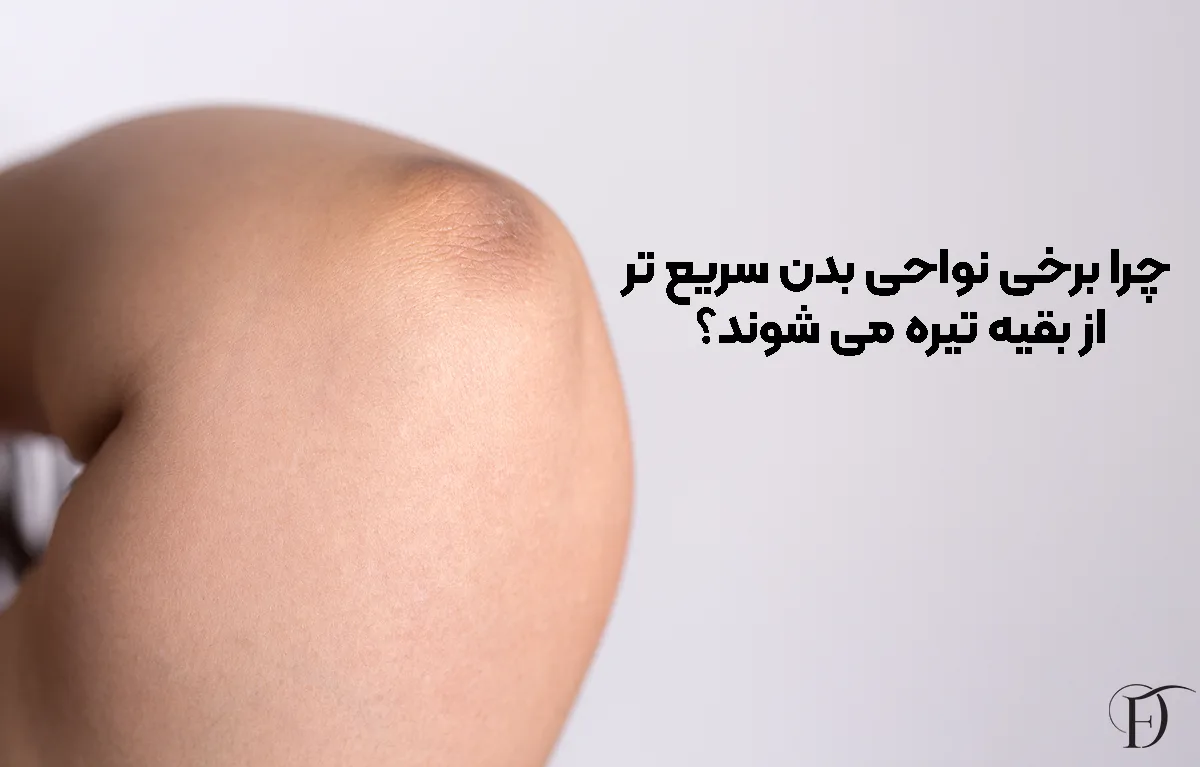چرا برخی نواحی بدن سریع ‌تر از بقیه تیره می ‌شوند؟