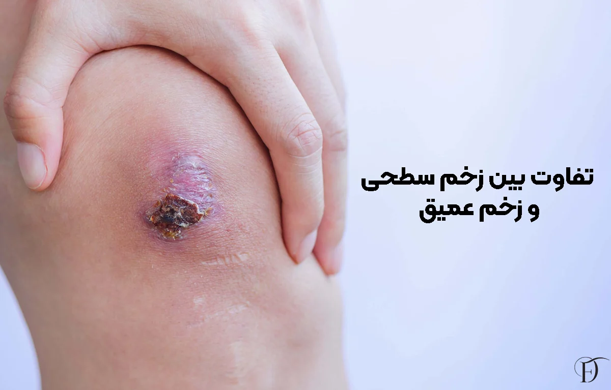 تفاوت زخم سطحی و عمیق