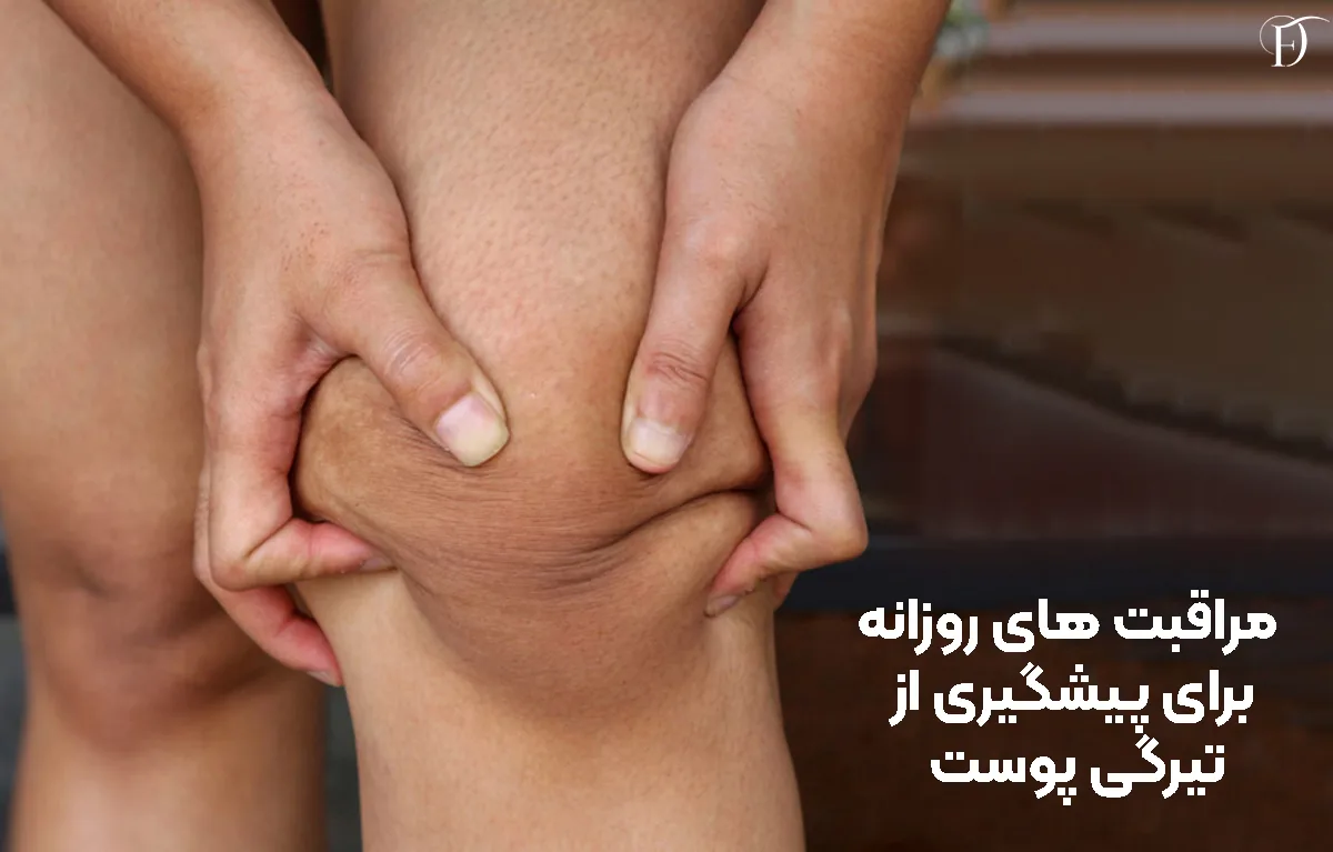 پیشگیری از تیزگی پوست