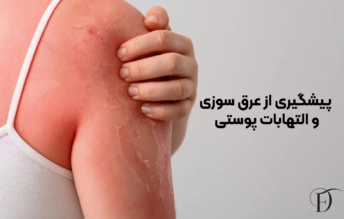 پیشگیری از عرق ‌سوزی و التهابات پوستی